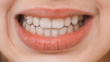 Why Do I Have White Stains on My Teeth and How Can I Treat Them?