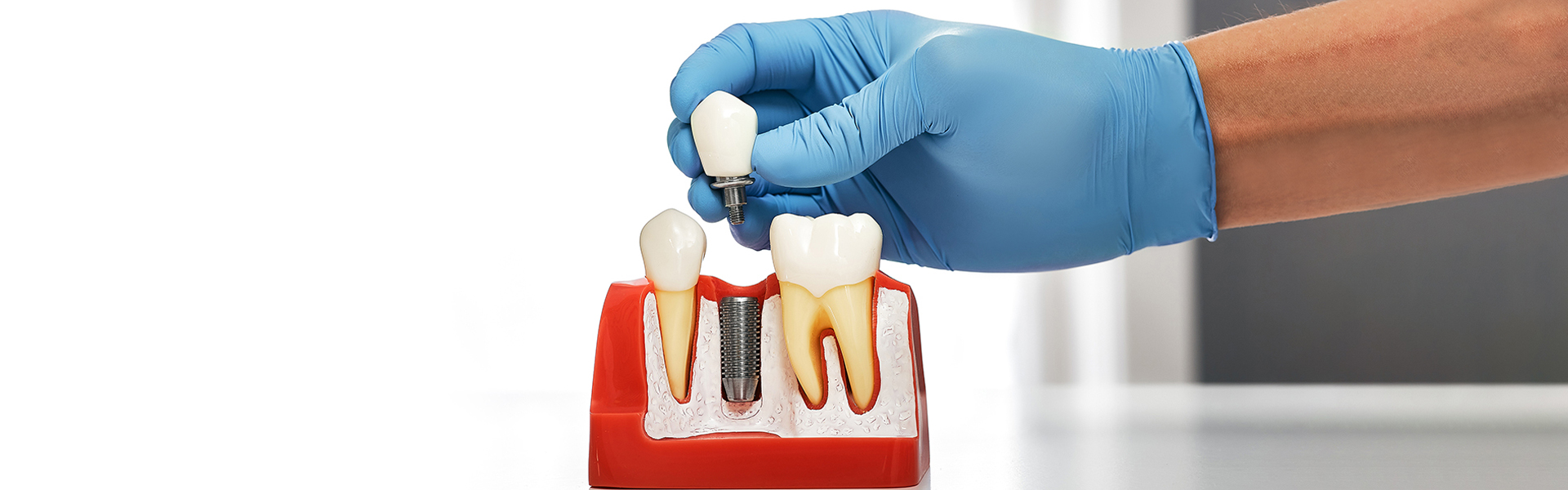 Are You a Candidate for Dental Implants? Frisco Experts Explain
