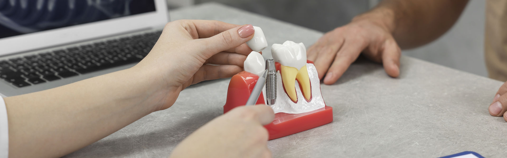 Top Benefits of Dental Implants in Frisco You Didn’t Know About