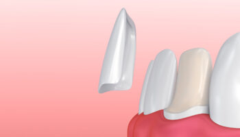 Thinking About Porcelain Veneers in Frisco, TX? Top Tips You Should Know