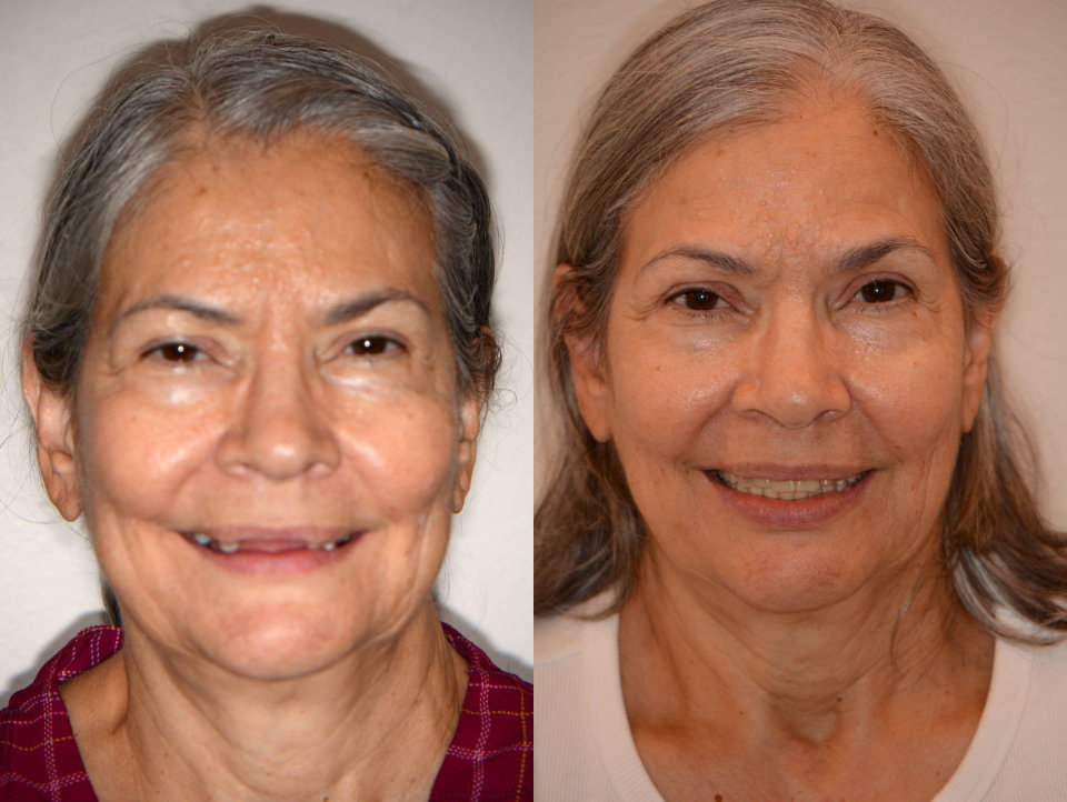 Older woman with gray hair shown in two side-by-side photos. Left: missing several upper teeth, smiling. Right: smiling with a full set of teeth, before and after dental treatment.