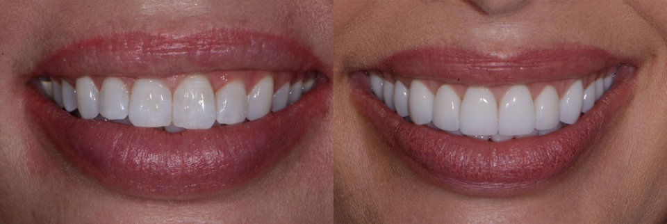 Two close-up images of a persons smile side by side, showing teeth before and after dental treatment; the right image displays whiter, more even teeth.