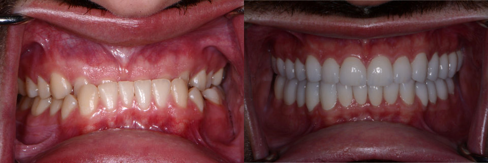 Split image showing close-up of a mouth: left side features natural teeth with gum recession, right side shows the same mouth with even, white dental veneers or crowns.