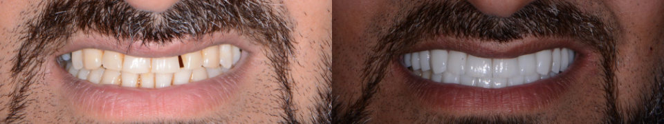 A close-up shows a persons smile before and after dental treatment—the left with yellowed, uneven teeth, and the right with straight, white teeth.