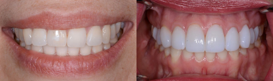 Close-up of two smiles: left shows lips and teeth, right shows teeth and gums with lips retracted, highlighting straight, white teeth in both images.