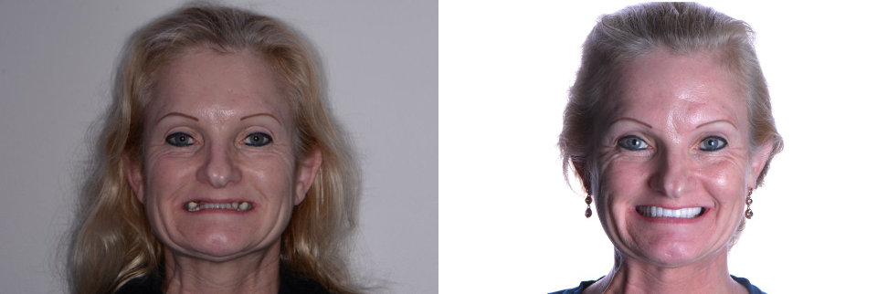 Side-by-side comparison of a woman before and after dental restoration, showing improved teeth alignment and a brighter smile in the after photo.