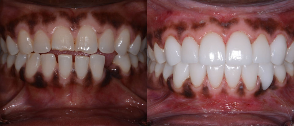 Two close-up images of teeth and gums. The left shows natural teeth with dark gum pigmentation; the right shows whiter, even teeth and lighter gums, indicating dental and gum treatment.