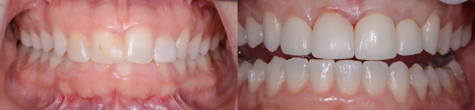 Side-by-side close-up of teeth, showing a before image with uneven, slightly yellow teeth on the left, and an after image with straight, white, well-aligned teeth on the right.