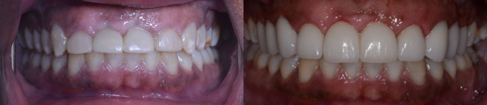 Close-up of two sets of teeth, side by side. The left shows natural teeth with some discoloration, while the right shows brighter, whiter teeth, suggesting a dental treatment or whitening comparison.