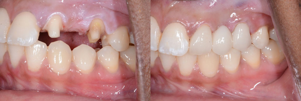 Side-by-side close-up of teeth: the left shows a missing upper front tooth and gap; the right shows the same mouth after dental restoration with the gap filled and teeth aligned.