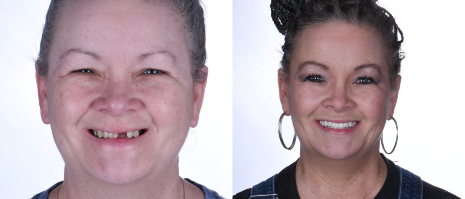 Side-by-side photos of a smiling woman before and after dental work; the left image shows missing teeth, while the right image shows a full set of even, white teeth.