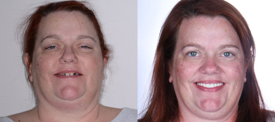 Side-by-side photos of a woman with red hair; left image shows her with a gap in her front teeth, right image shows her with the gap closed and an improved smile.