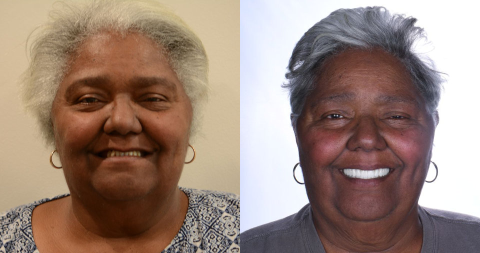 Side-by-side photos of an older woman with gray hair, both wearing hoop earrings; in the left image she is smiling slightly, in the right image she is broadly smiling, showing her teeth.