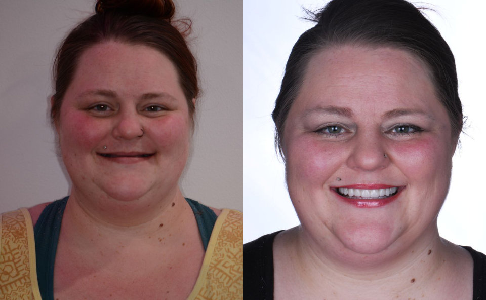Side-by-side photos of a woman before and after, showing noticeable weight loss and a brighter smile in the after photo.