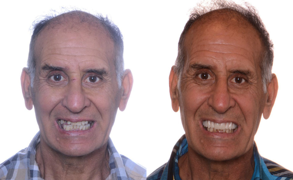 Two older men with receding hairlines are smiling, showing their teeth, against a white background. Both are wearing plaid shirts and appear to be posing for comparison photos.